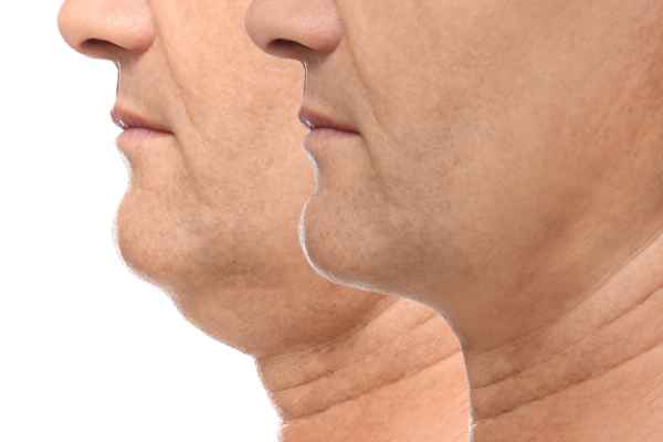 HIFU - Breakthrough in Anti - ageing 2 hifu results Billingshurst