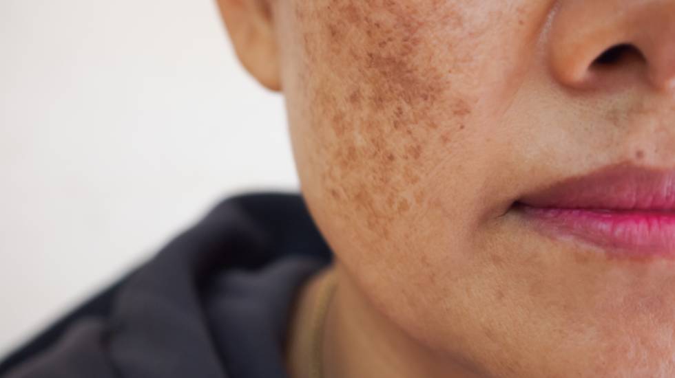 Ephelides Treatment Billingshurst