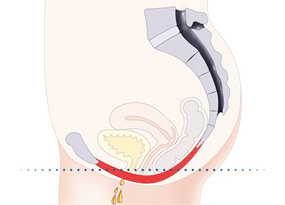 Pelvic-Floor Muscle Repair 5 Pelvic floor muscles Billingshurst