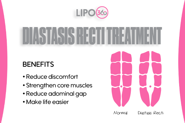 Revolutionising Muscle Repair: The Power of LIPO360 Body Sculpt Post-Injury 5 diastasis recti treatment Billingshurst