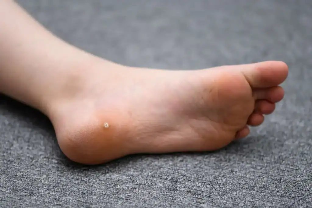 Cryotherapy For Warts And Also Verrucas 2 Image of verruca on the bottom of the foot that able to be treated with Cryotherapy Billingshurst