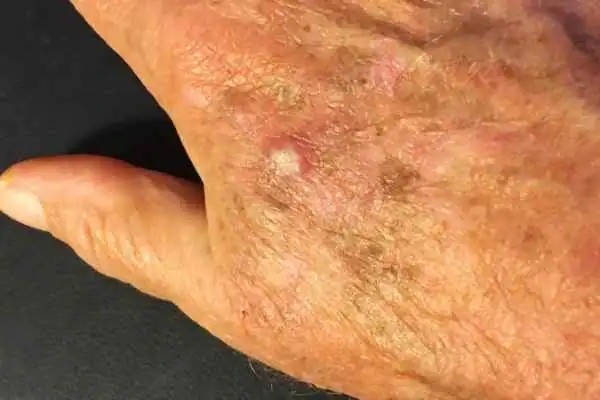 Image of Actinic keratoses Billingshurst on a person hand