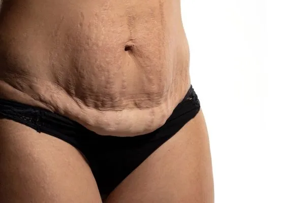 The science behind skin tightening Billingshurst picture of a woman's sagging skin on the stomach